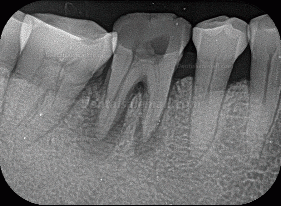 Fussen F200 Dental Phosphor Plate Scanner X Ray Imaging PSP Scanner